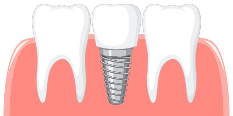 Journal of Dentistry and Oral Implants - Periimplantitis