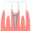 Journal of Dentistry and Oral Implants - Periimplantitis